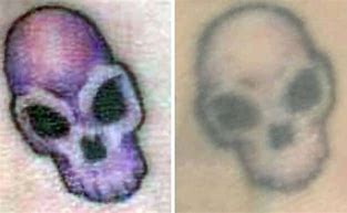 Remove Tattoo Without Laser