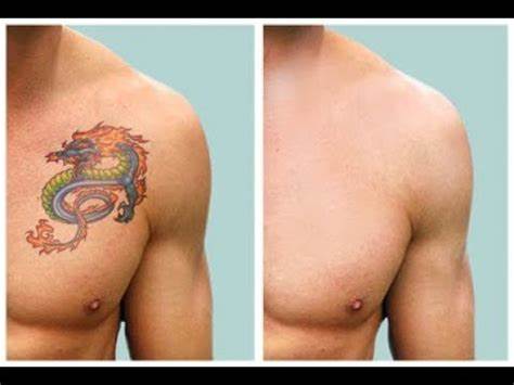 Remove Tattoo Without Laser